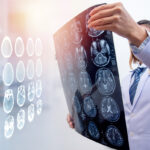 woman doctor holding MRI film to diagnosis injury area of brain