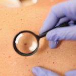 Gloved doctor dermatologist with magnifying glass examines skin of patient.