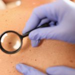 Gloved doctor dermatologist with magnifying glass examines skin of patient.